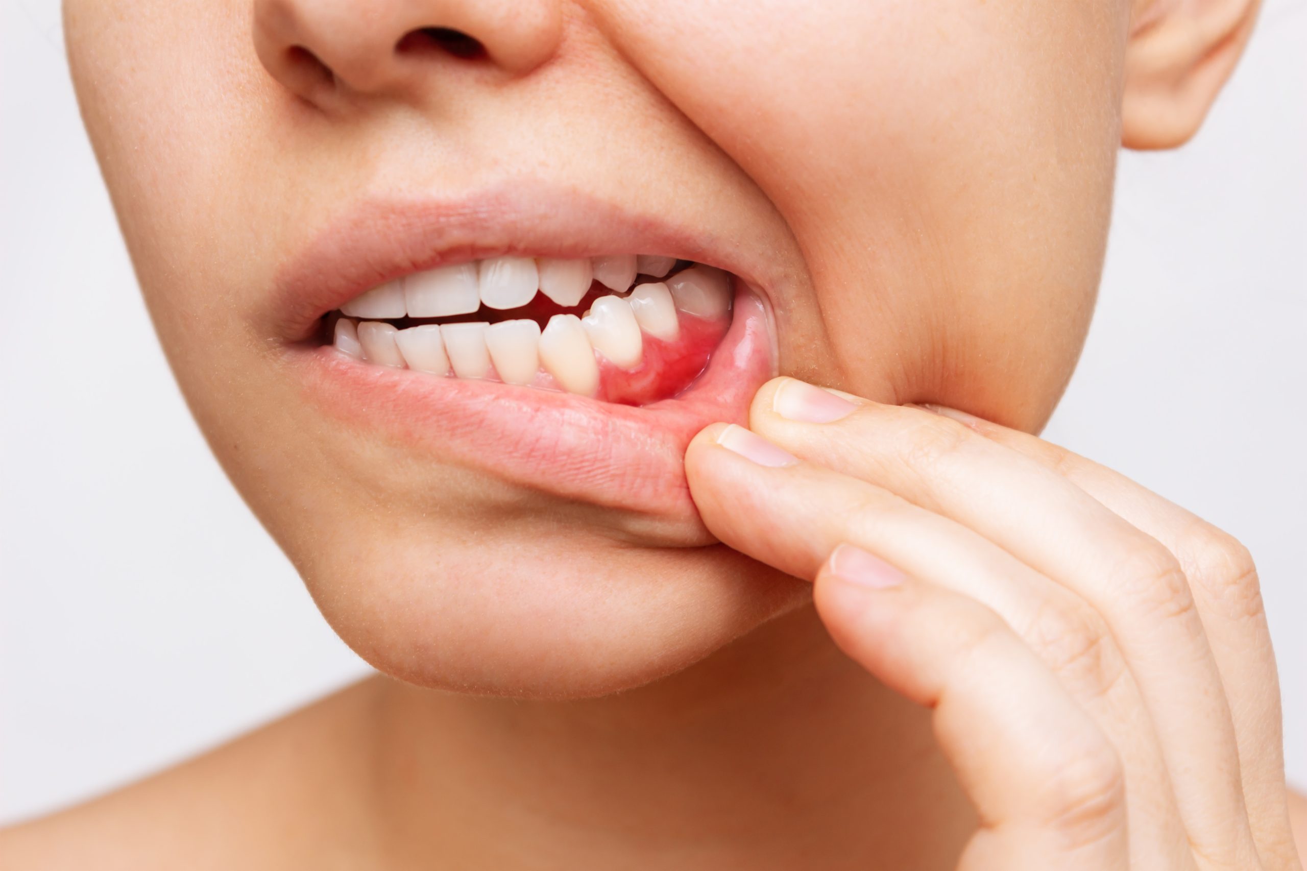 gum-inflammation-cropped-shot-young-woman-showing-red-bleeding-gums