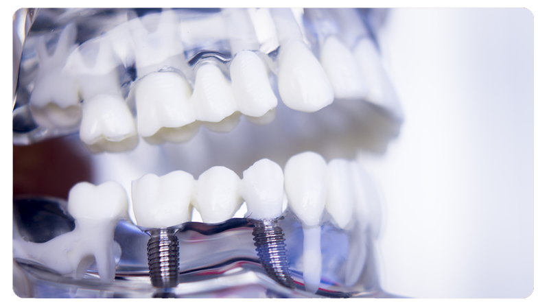 bionika_implant