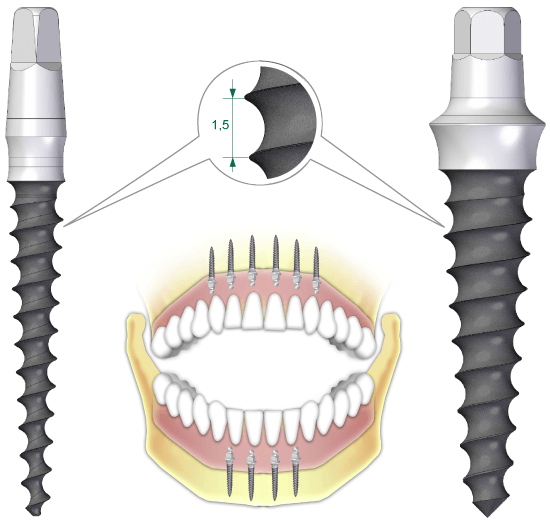 The round headed Conefit Slim implants are suitable for the usage of removable toothworks with inserting 2-6 implants.