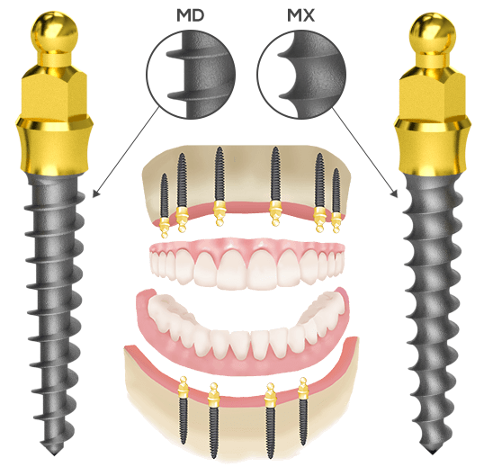 A Nanoplant Implantátumok kivehető fogművekhez alkalmazhatók 2-6 implantátum beültetésével.