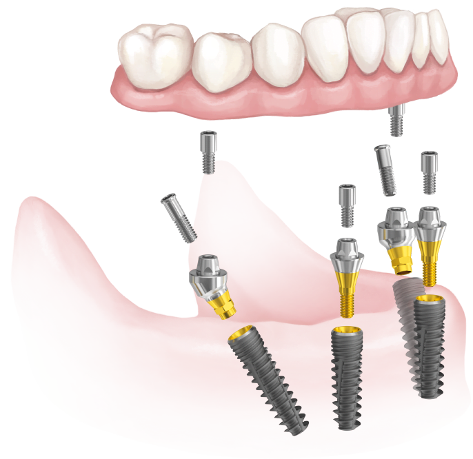 BIONIKA Ecoplant Implant All-on4 megoldás