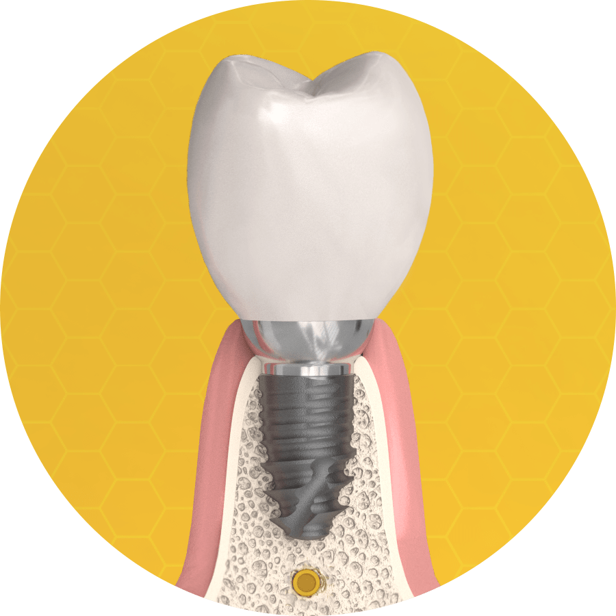 The application of Cortilog Short extra short implants in the case of low bone supply, due to the nerve canal, small space is provided, but the short implant is a suitable solution for problems.