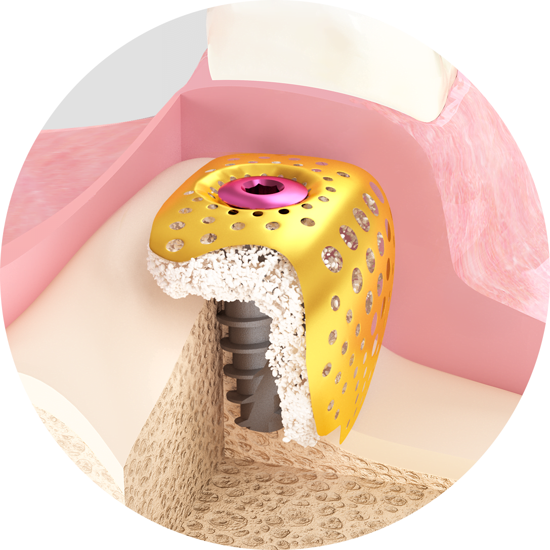 A 3D Builder membrán alkalmazásának ábrája. A csonthiányt csontpótló anyaggal fedik be, ezt tartja helyben a 3D Builder háló, egyszerűen, zárócsavarral rögzítve az implantátumhoz.