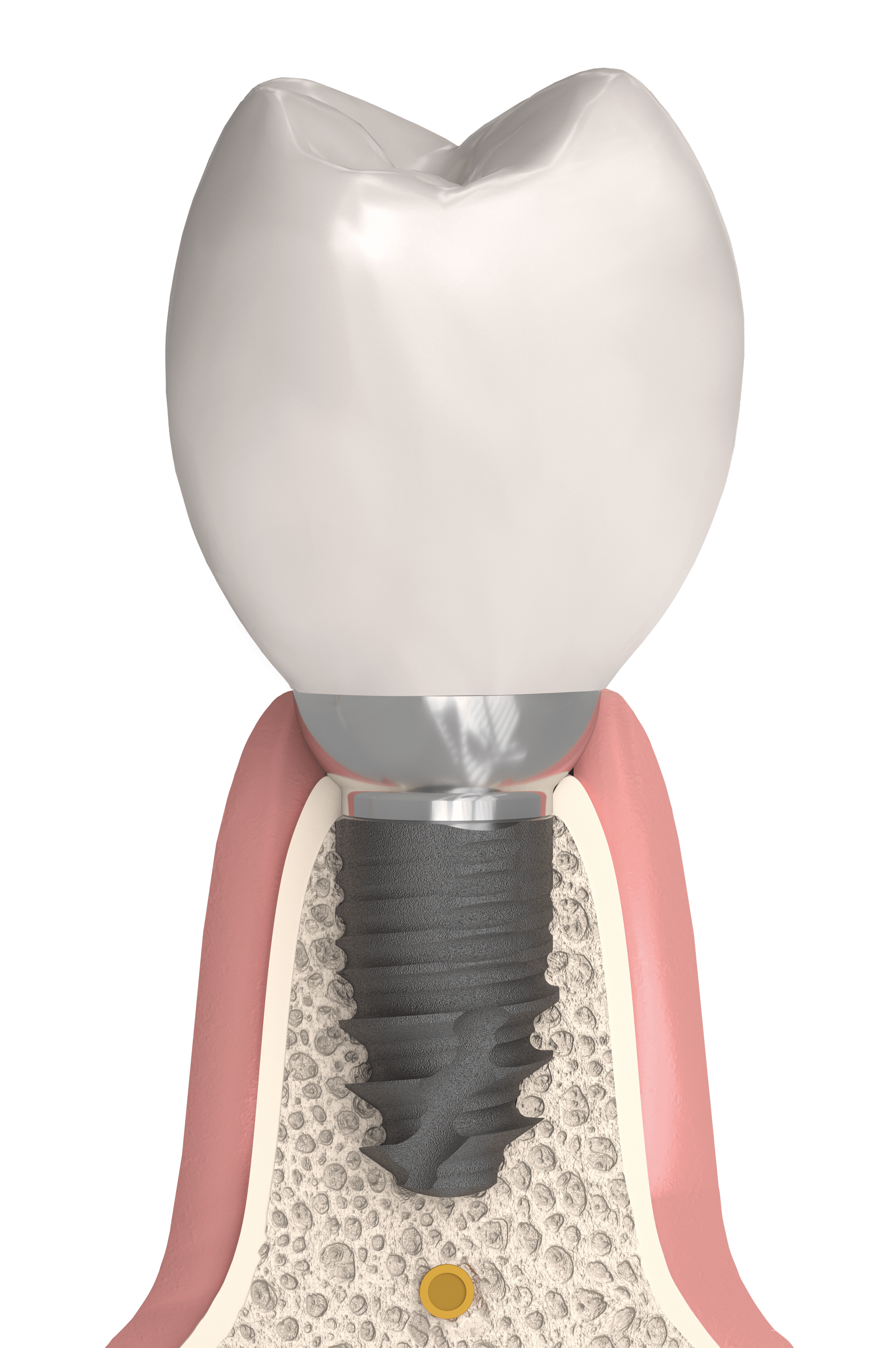 Cortilog short implantátum rendszer, Cortilog short kétfázisú implantátum