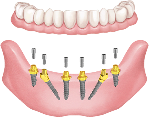Csavarozható "all-on-6" megoldás 6 db Hybrid mini implantátummal, multi-unit felépítményekkel.é