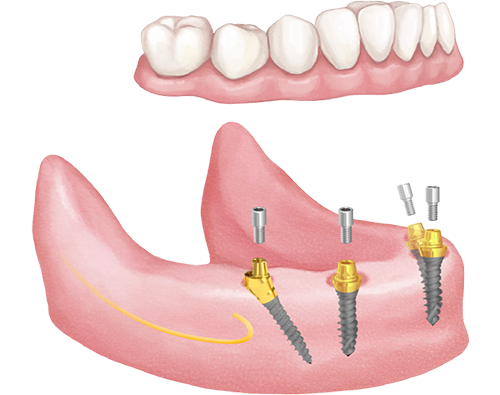 Csavarozott All-on-4 megoldás Hybrid mini implantátumokkal és multi-unit felépítményekkel.