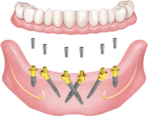 Csavarozott X-Cross megoldás Hybrid mini implantátumokkal és multi-unit felépítményekkel. A két elülső imlantátum egymással kereszt irányba kerül beültetésre.