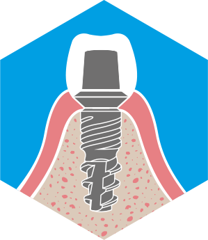 fogászati implantátum