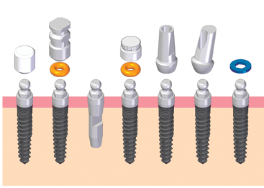 The elements of the Nano telescope are the implants, o-ringed cap, technical implant, sampling head, healing cap, anatomical heads( straight and oblique)