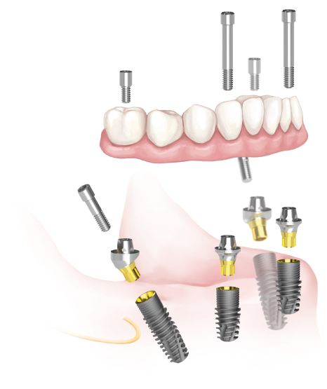 Gazdaságos megoldásként akár már 2 implantátum beültetésével lehetőség van teljes foghiány megszüntetésére, noha ez esetben az implantátumok csak az elhorgonyzást biztosítják, de ezen felül bátrabban ajánljuk a 4 vagy 6 implantátummal történő All-on-4 vagy All-on-6 fogpótlási módszerket.