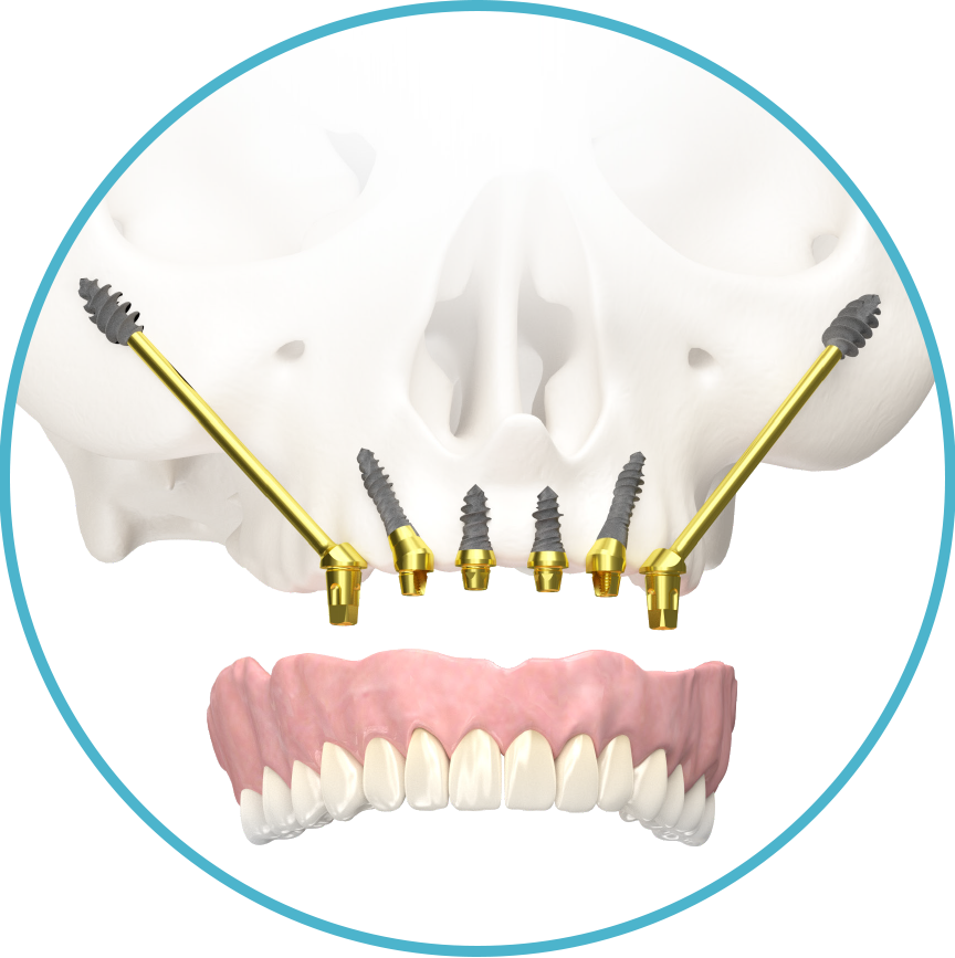 Extra long Hybrid Zygomat implants inserted into the yoke bone for extended bone deficiency.